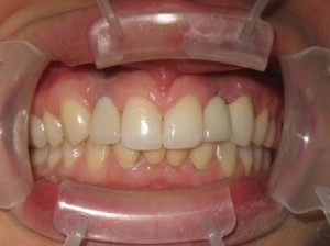 Sage Dental Pocatello Idaho After Dental Work