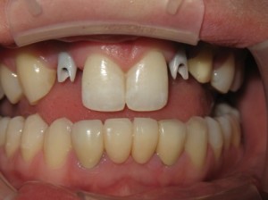Sage Dental Pocatello Idaho before dental work
