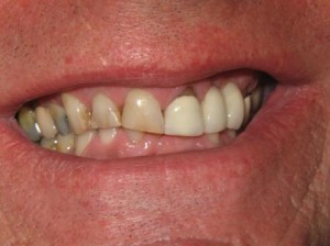 Sage Dental Pocatello Idaho Before Photo