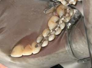 Sage Dental Pocatello Idaho white fillings