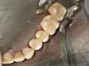 Sage Dental Pocatello Idaho white fillings