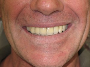 Sage Dental Pocatello Idaho Dental Implants